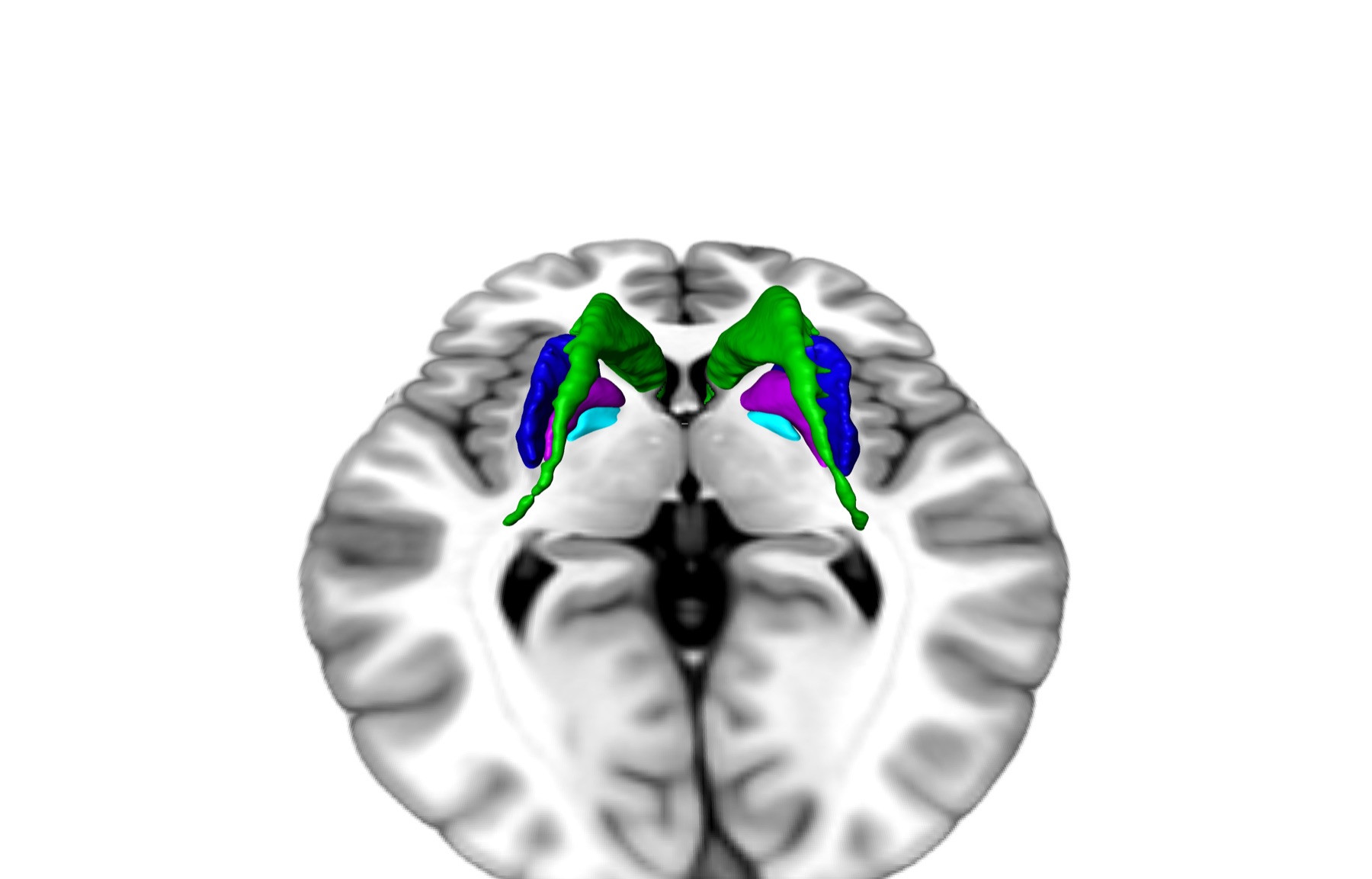 Three-dimensional multimodal SWAN visualization teaser